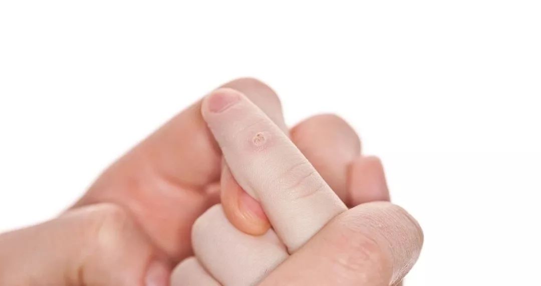 為什么會(huì)長疣 (臉上為什么會(huì)長疣)