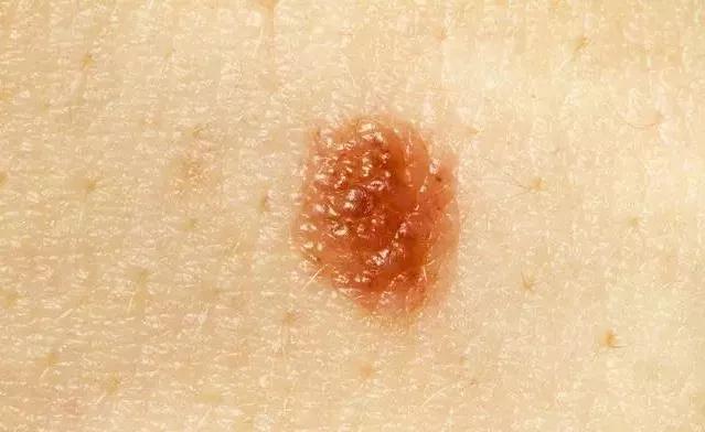 身上紅痣是怎么回事（女人身上長紅痣越來越多）