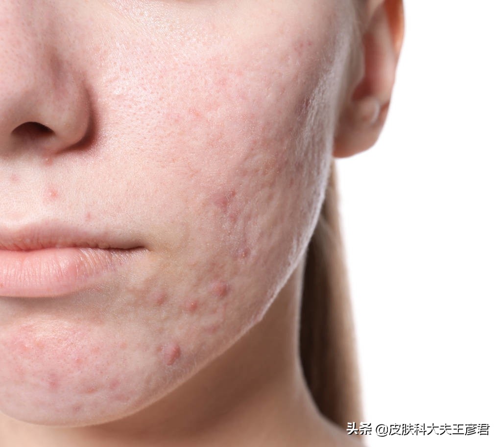為什么臉上會長痤瘡(臉上突然長痤瘡的原因)