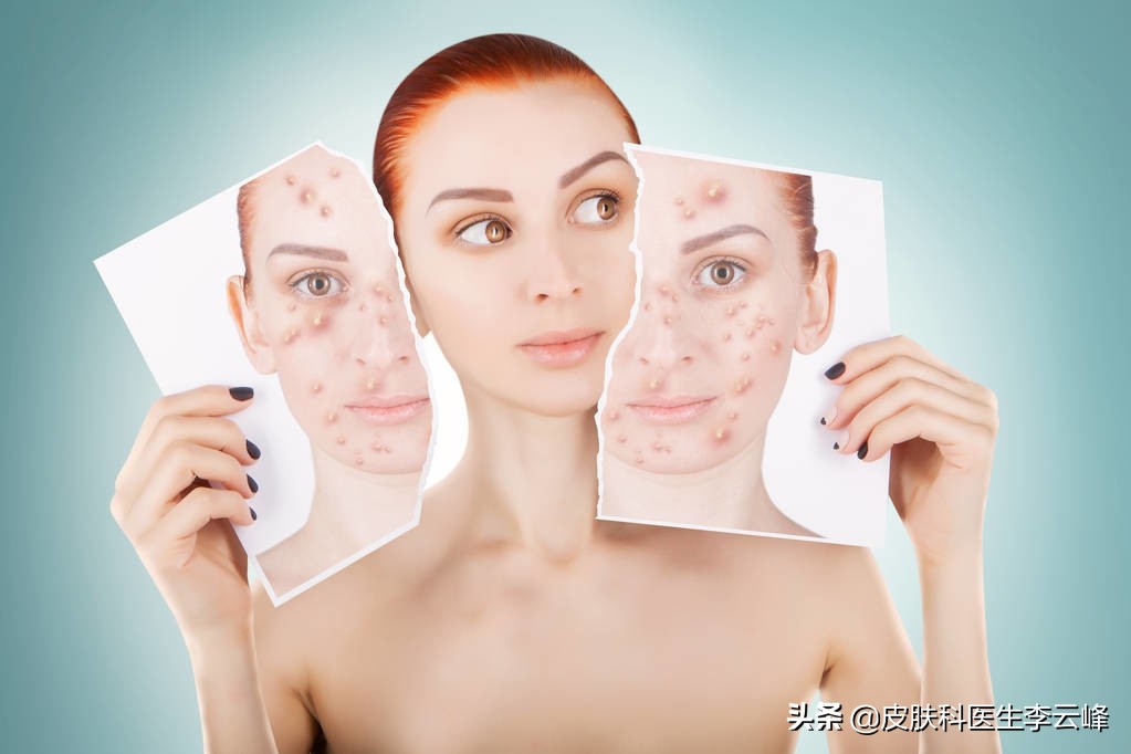 為什么會長痤瘡 (得了痤瘡怎么能盡快把它消下去)