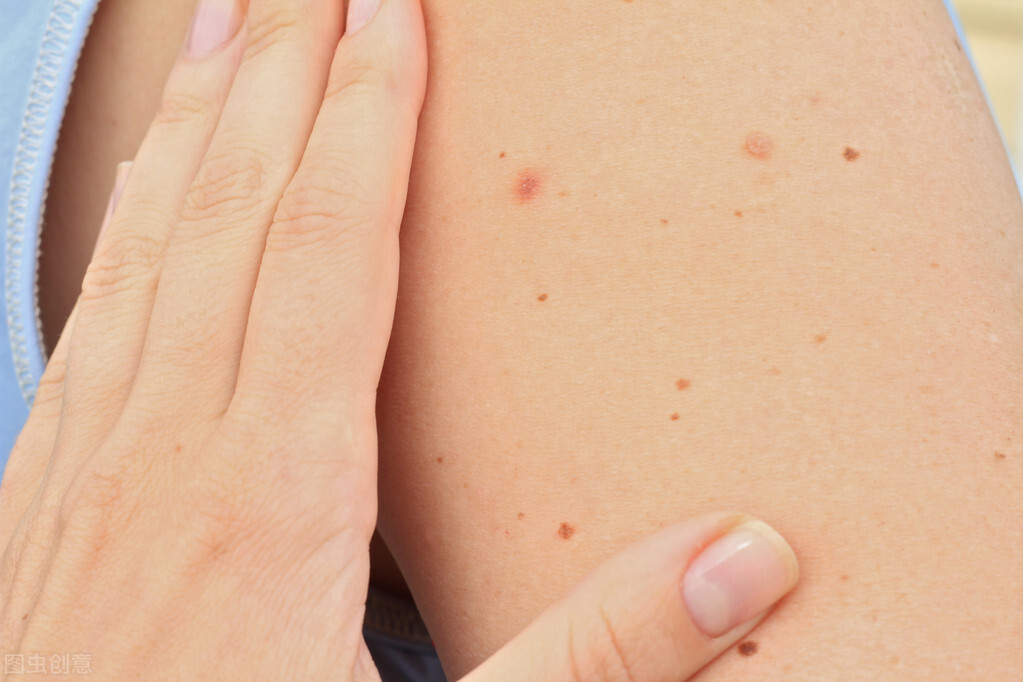 身上紅痣是怎么回事（女人身上長紅痣越來越多）