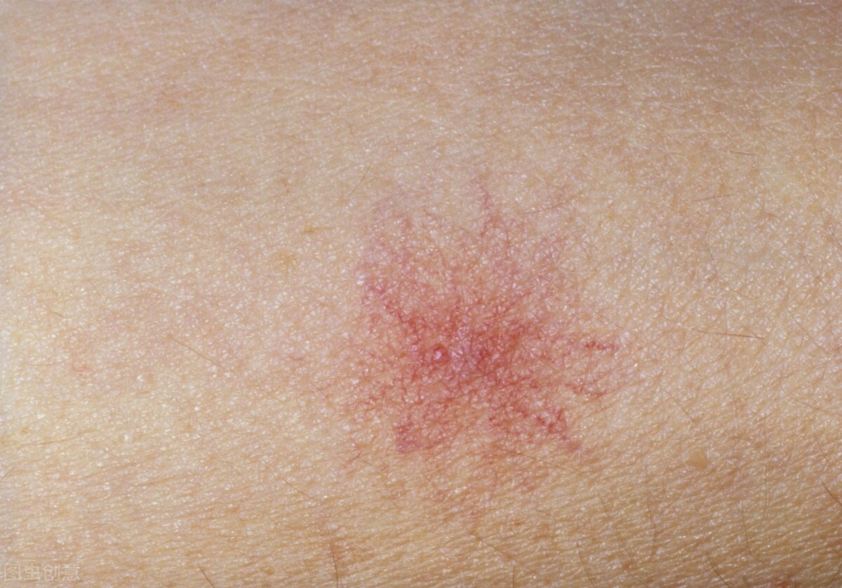 身上紅痣是怎么回事（女人身上長紅痣越來越多）