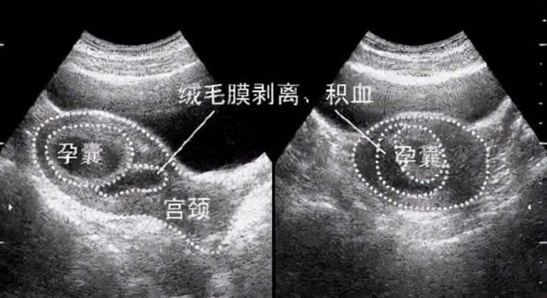 著床成功排出白帶圖片(受精卵著床的癥狀)