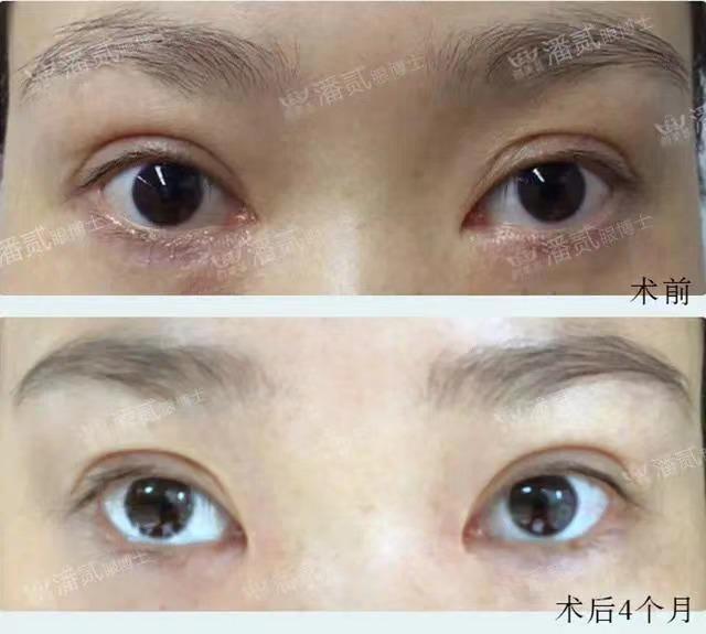 開眼角前后對比照片 開眼角失敗的八種圖片