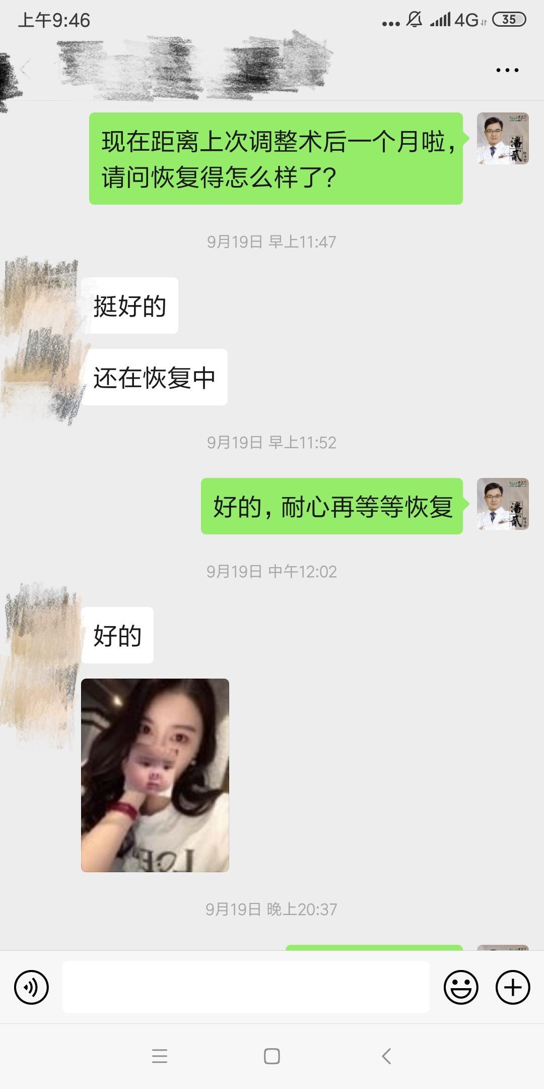 開眼角前后對比照片 開眼角失敗的八種圖片
