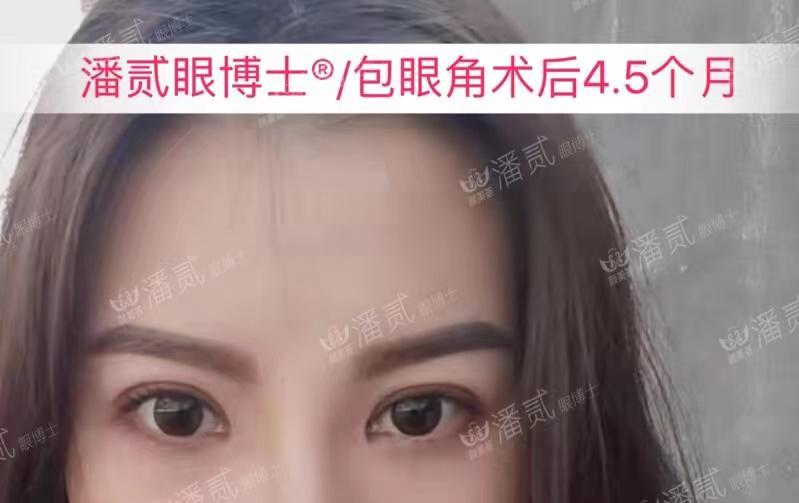 開眼角前后對比照片 開眼角失敗的八種圖片