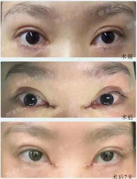 開眼角前后對比照片 開眼角失敗的八種圖片