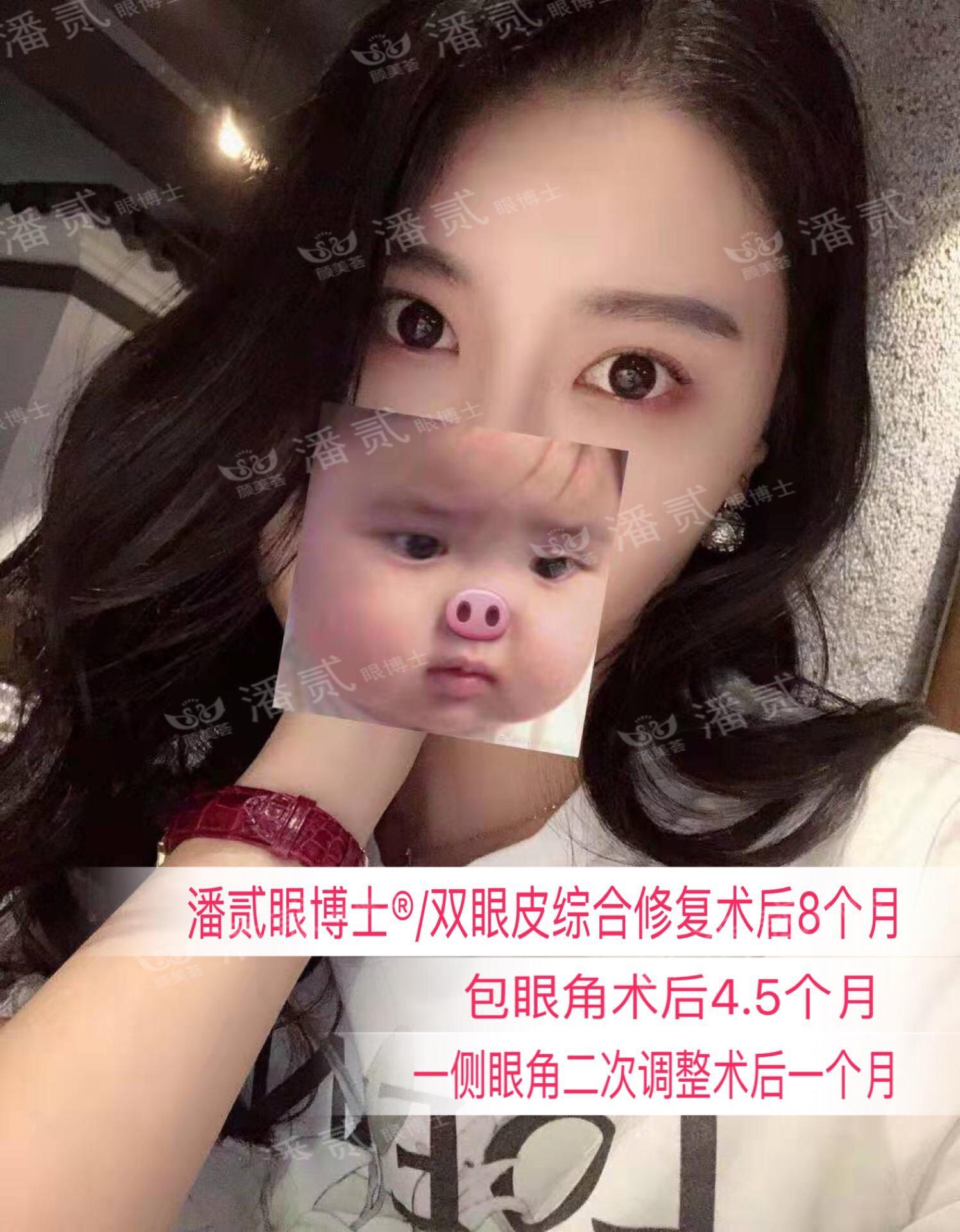 開眼角前后對比照片 開眼角失敗的八種圖片