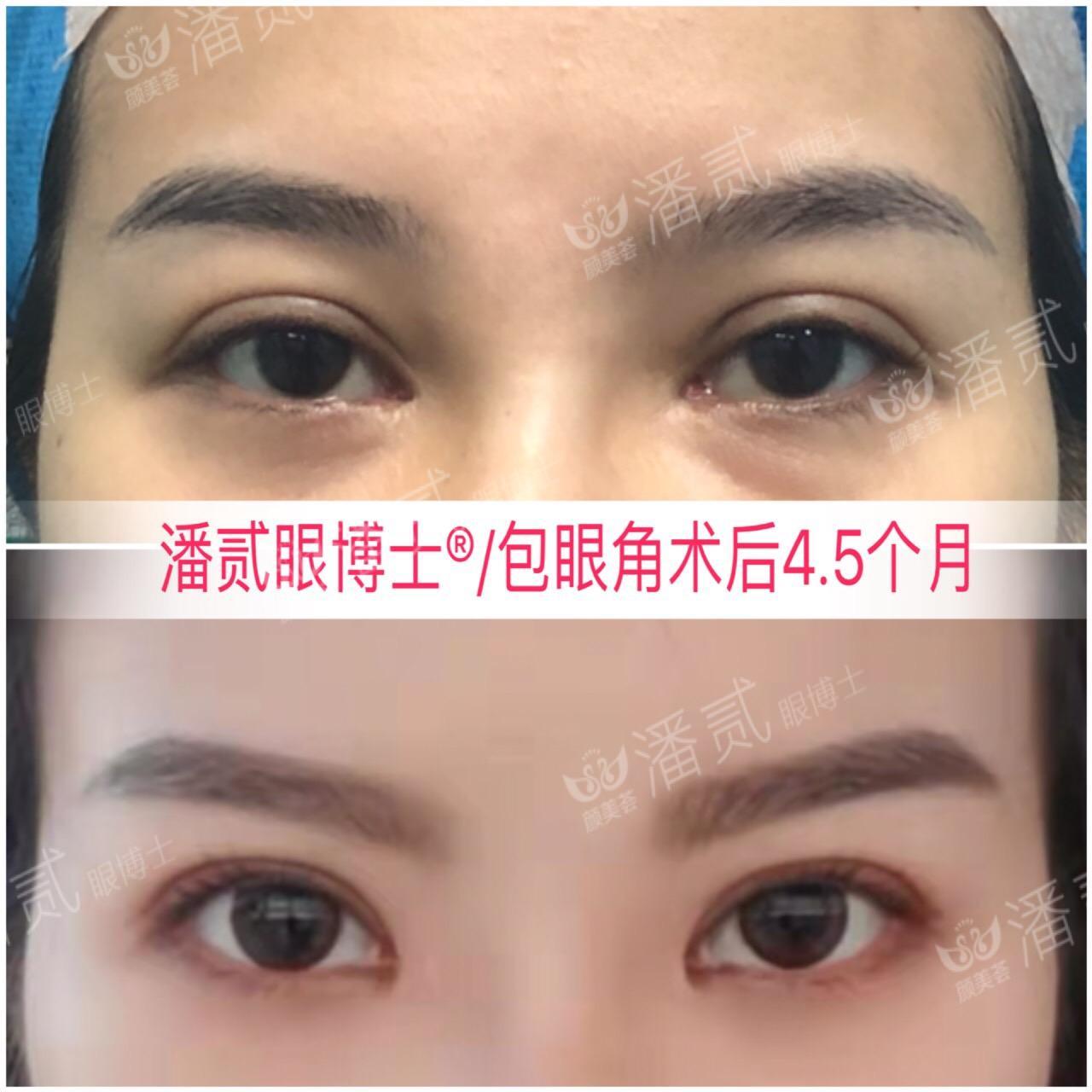 開眼角前后對比照片 開眼角失敗的八種圖片