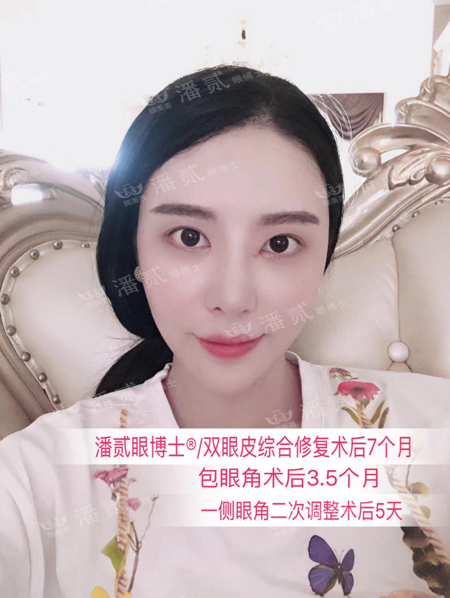 開眼角前后對比照片 開眼角失敗的八種圖片