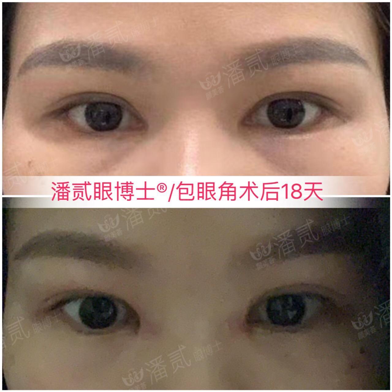 開眼角前后對比照片 開眼角失敗的八種圖片