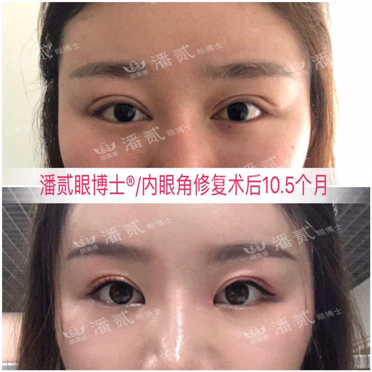 開眼角前后對比照片 開眼角失敗的八種圖片