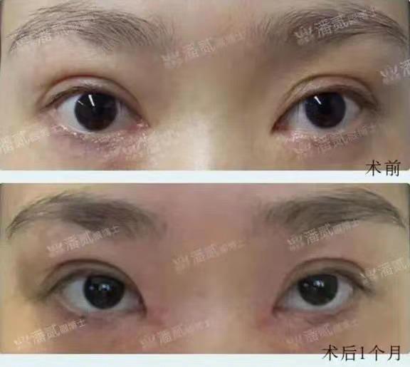開眼角前后對比照片 開眼角失敗的八種圖片