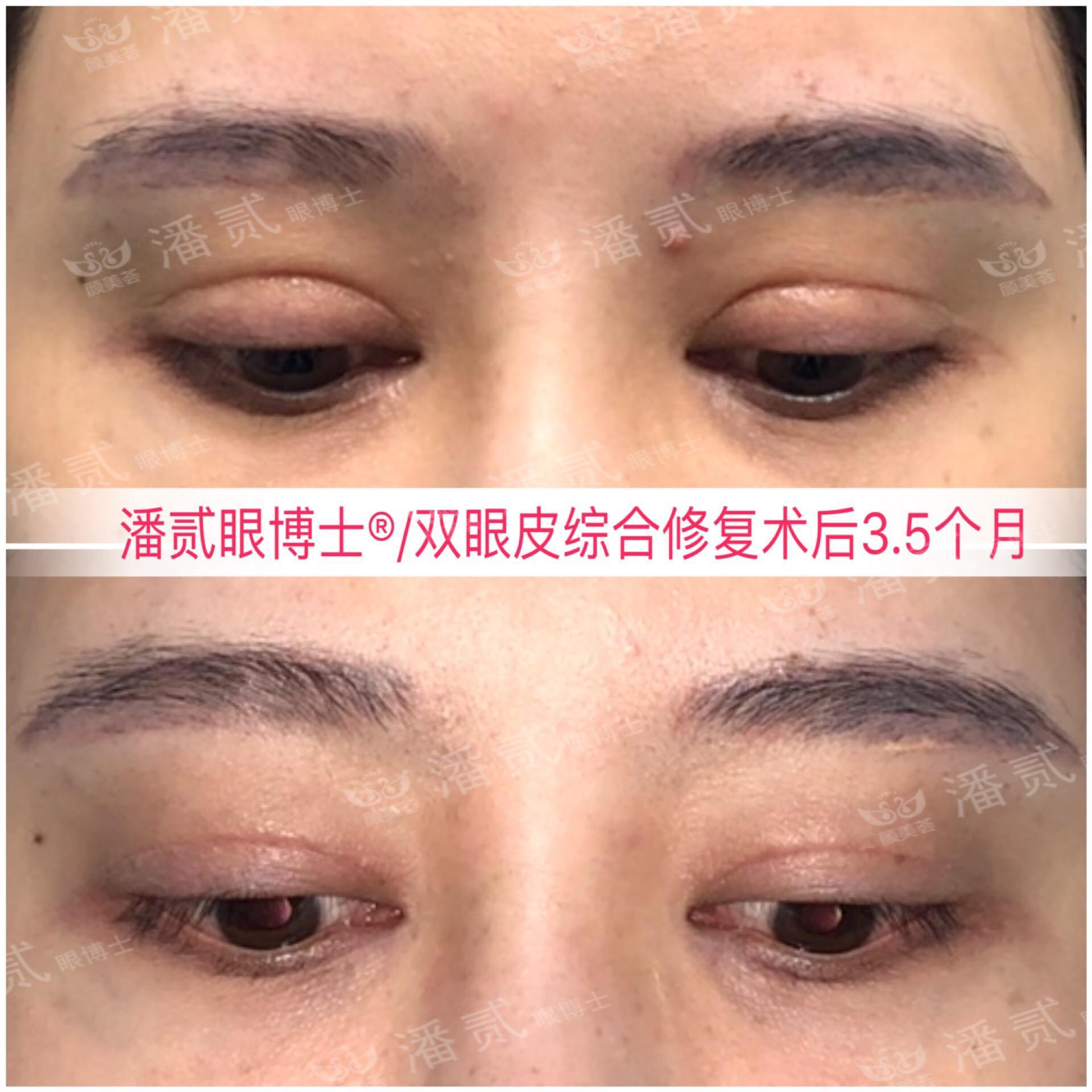 開眼角前后對比照片 開眼角失敗的八種圖片