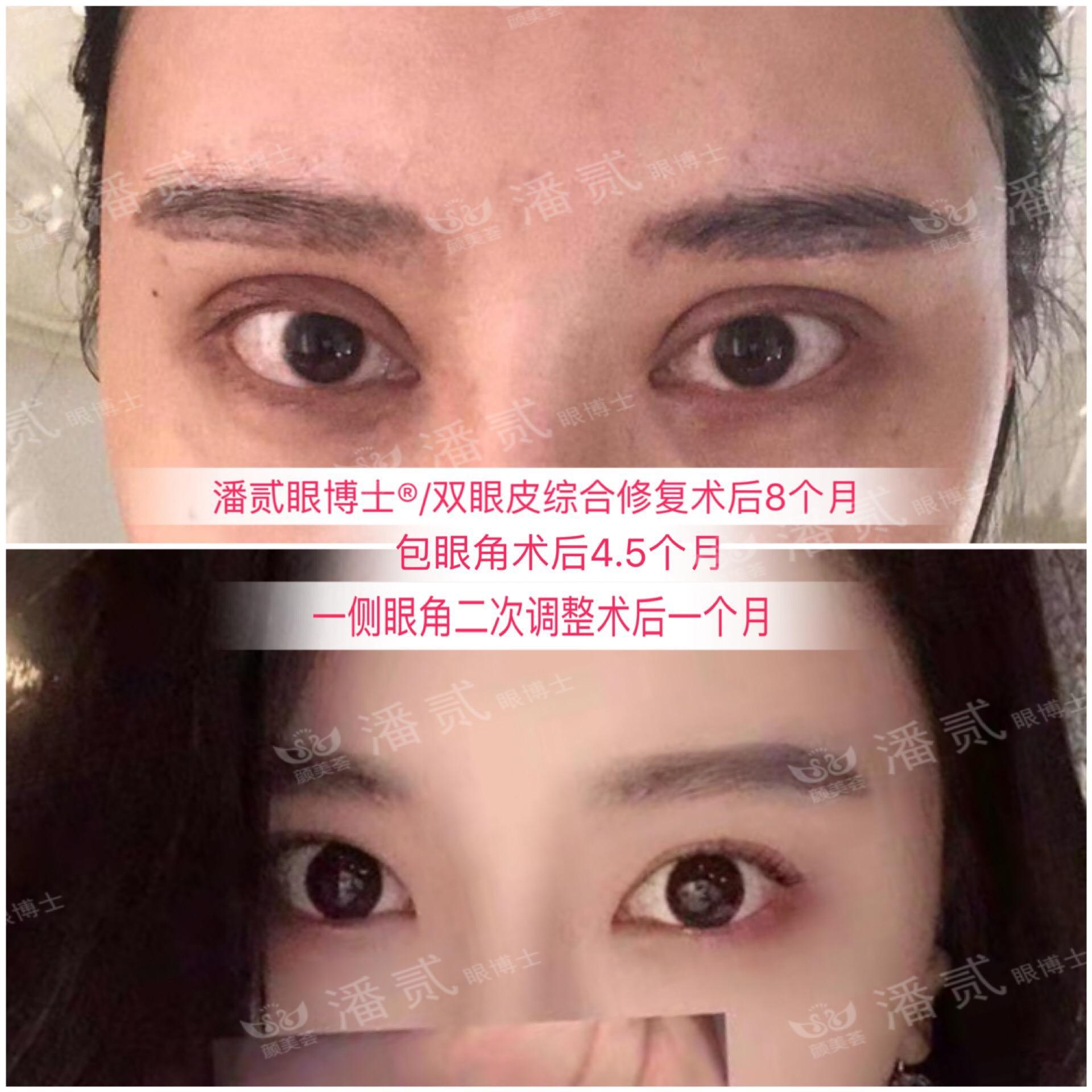 開眼角前后對比照片 開眼角失敗的八種圖片