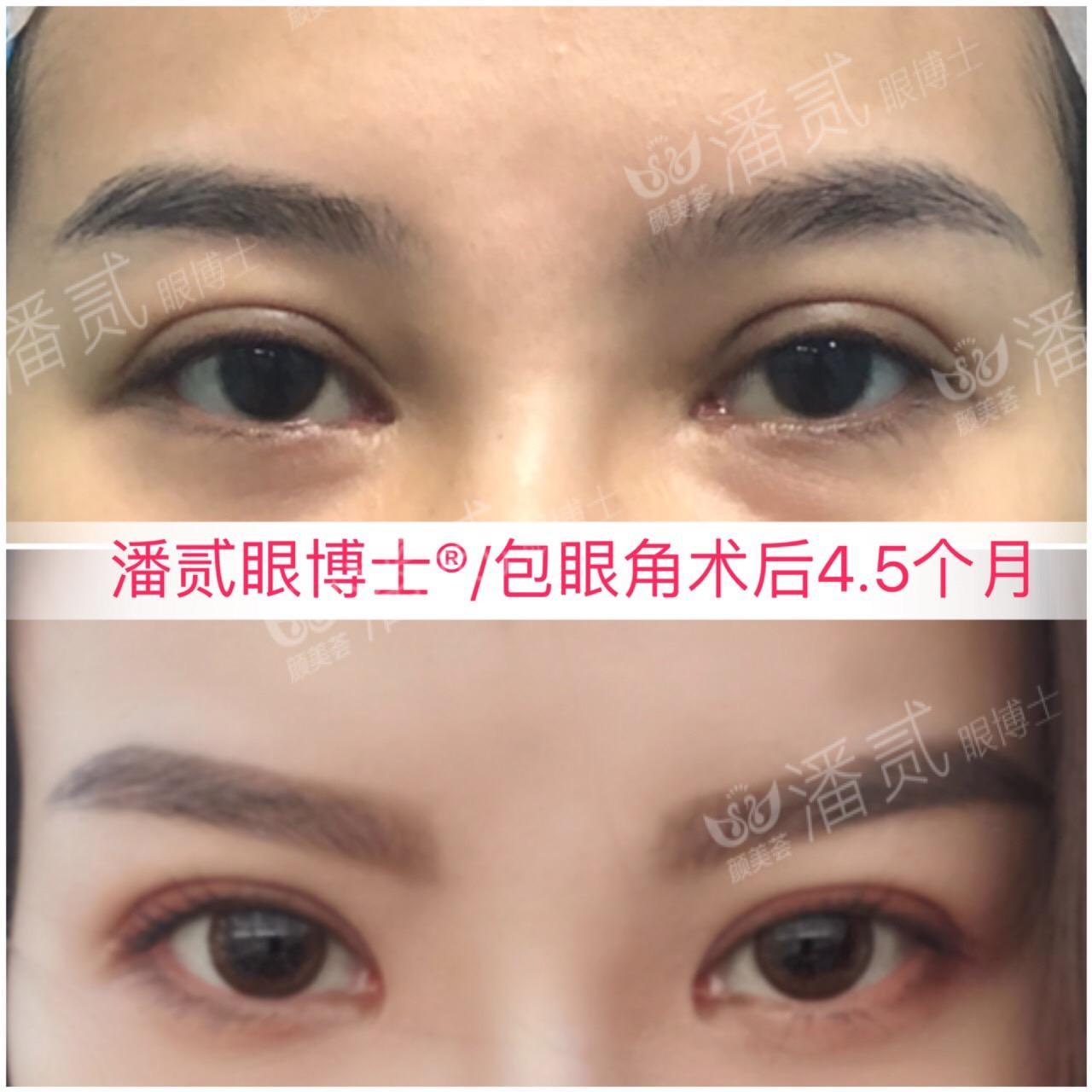 開眼角前后對比照片 開眼角失敗的八種圖片