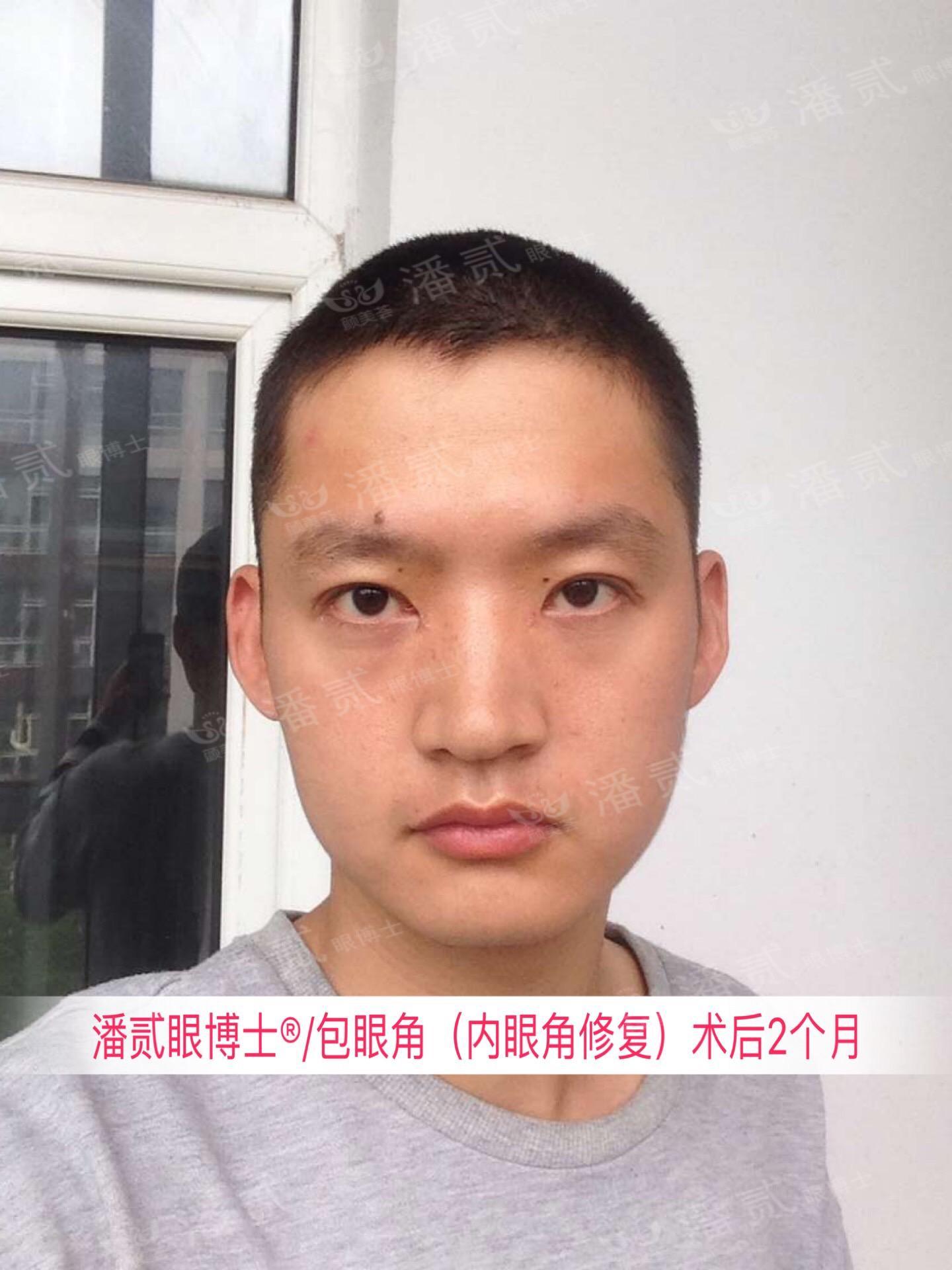 開眼角前后對比照片 開眼角失敗的八種圖片