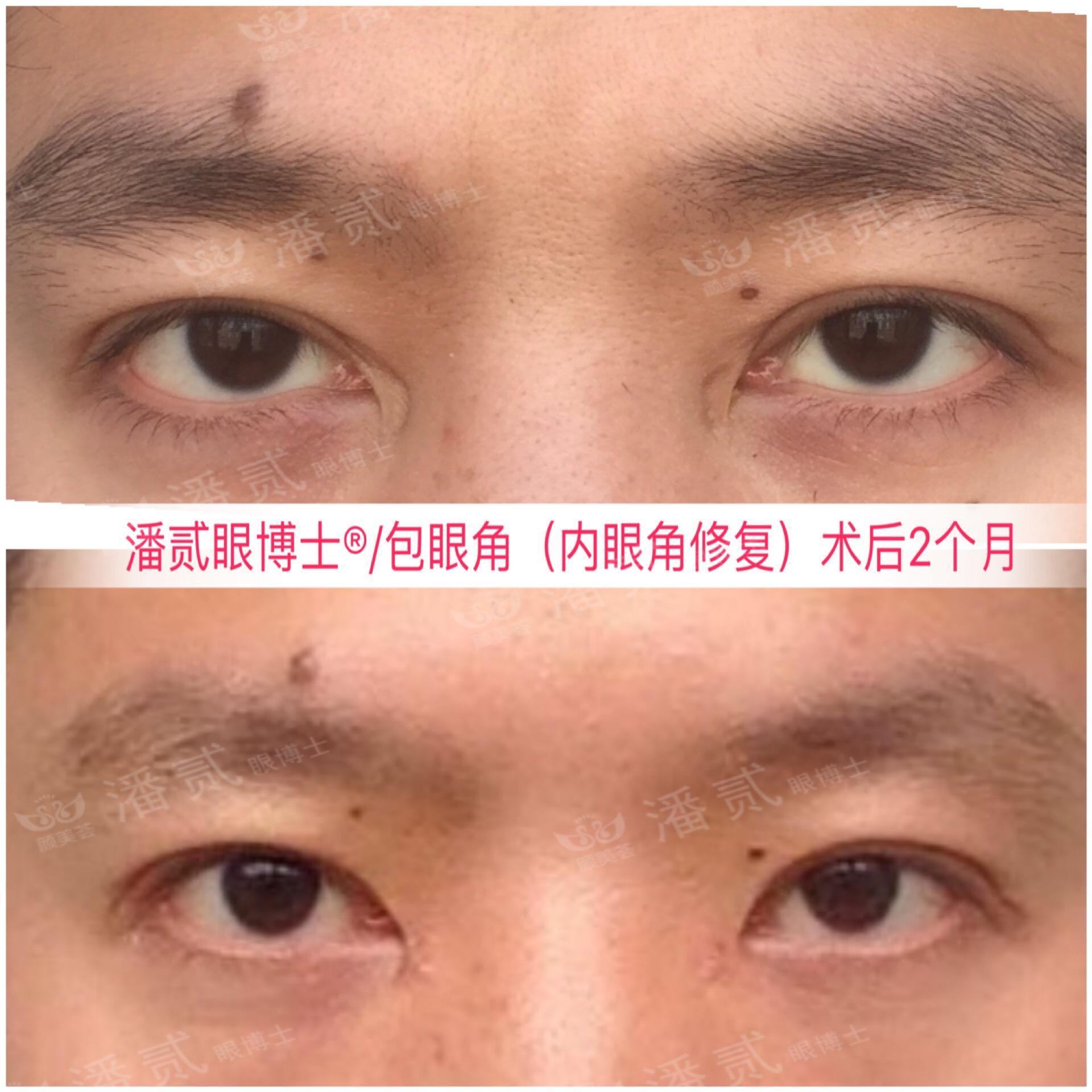 開眼角前后對比照片 開眼角失敗的八種圖片