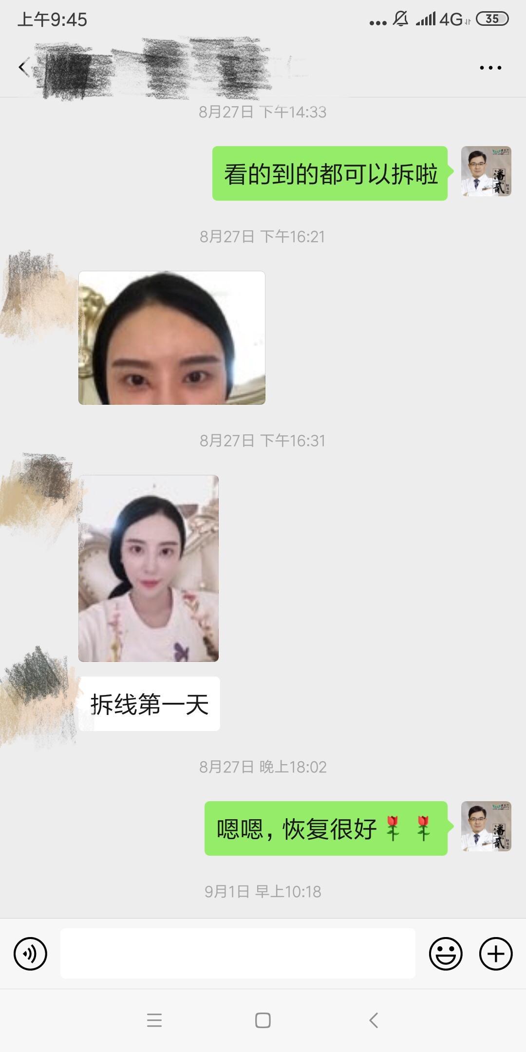 開眼角前后對比照片 開眼角失敗的八種圖片