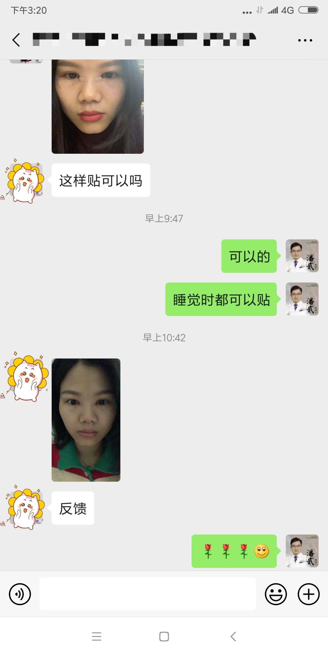 開眼角前后對比照片 開眼角失敗的八種圖片