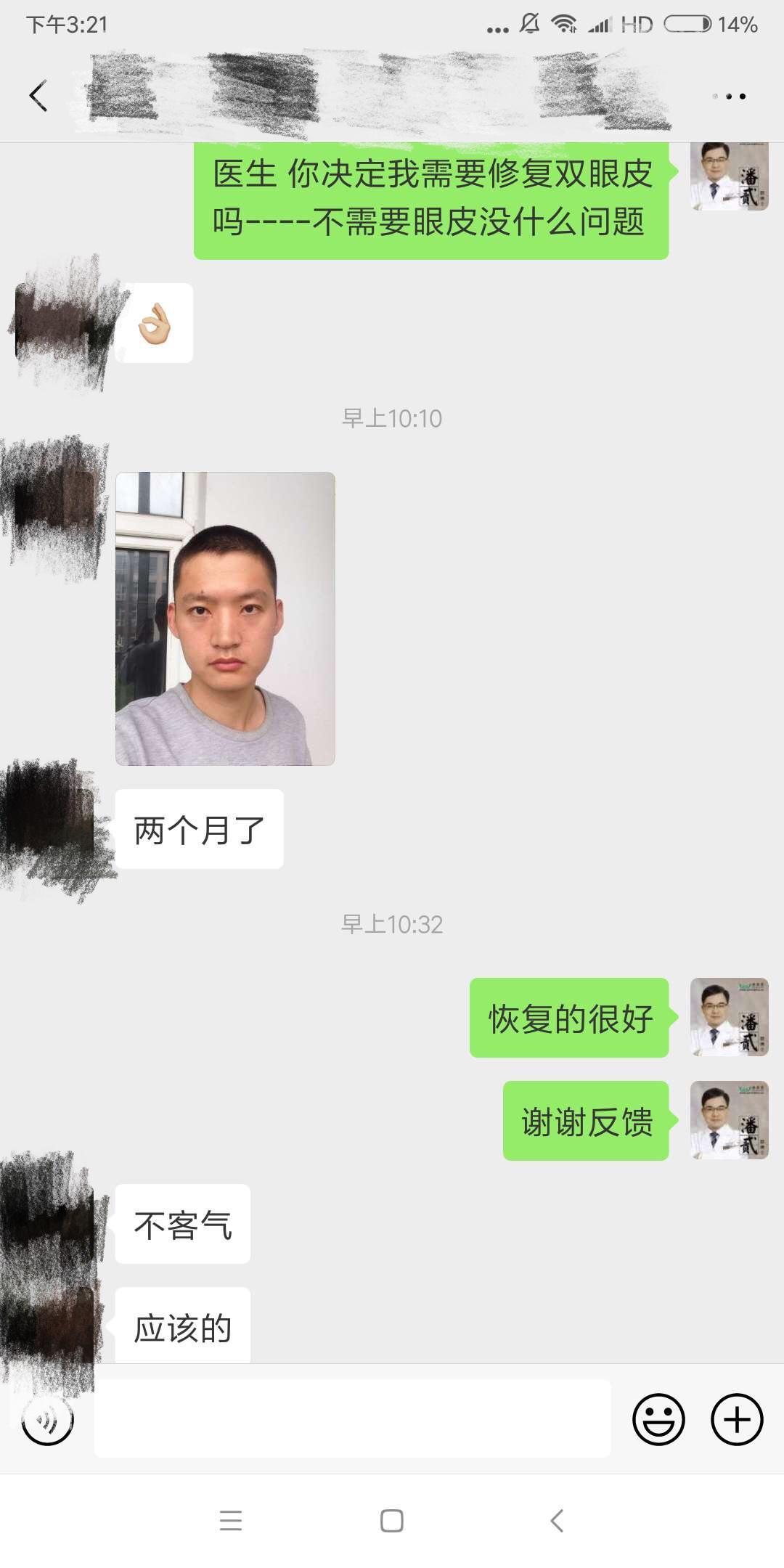 開眼角前后對比照片 開眼角失敗的八種圖片