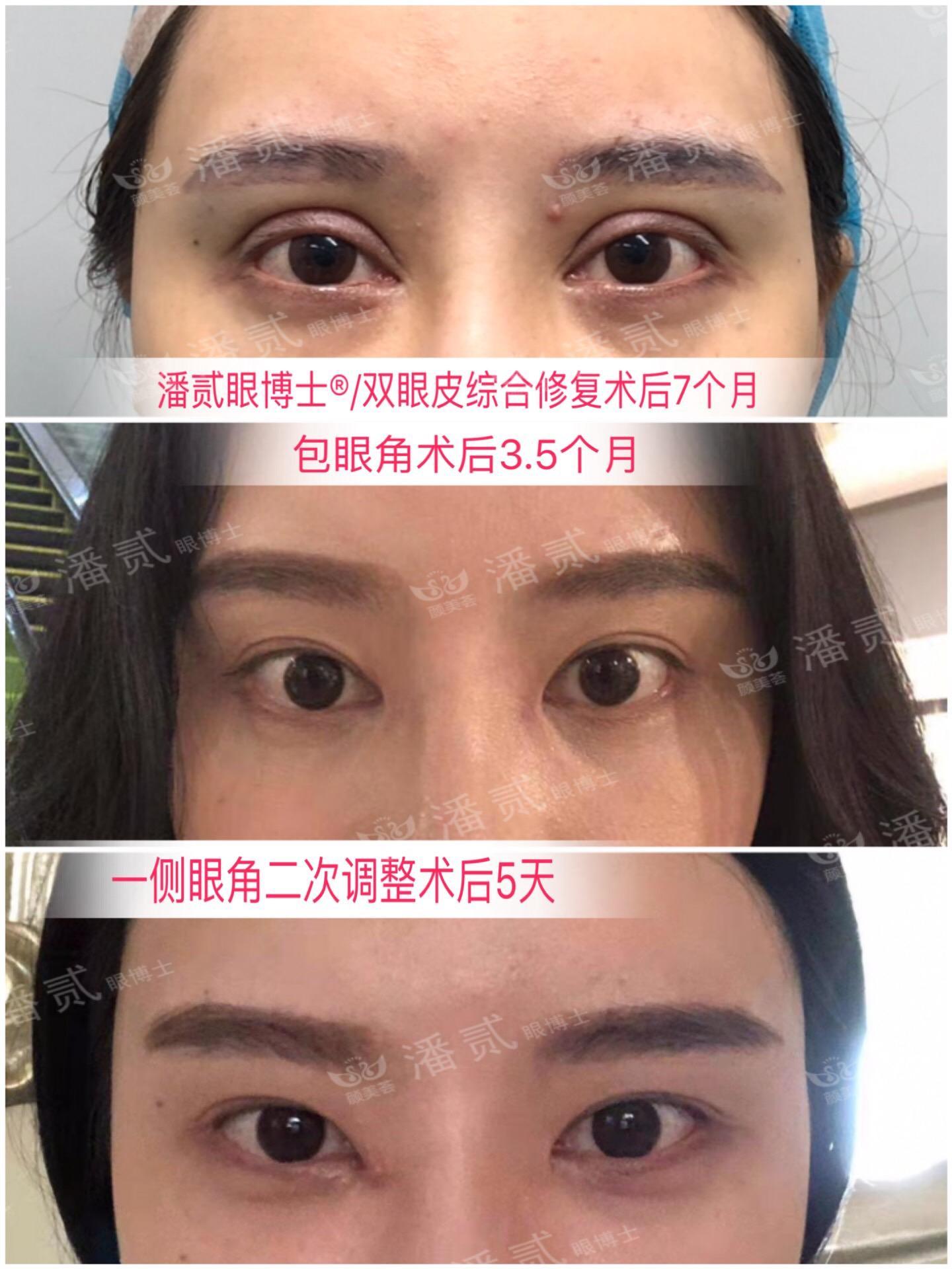 開眼角前后對比照片 開眼角失敗的八種圖片