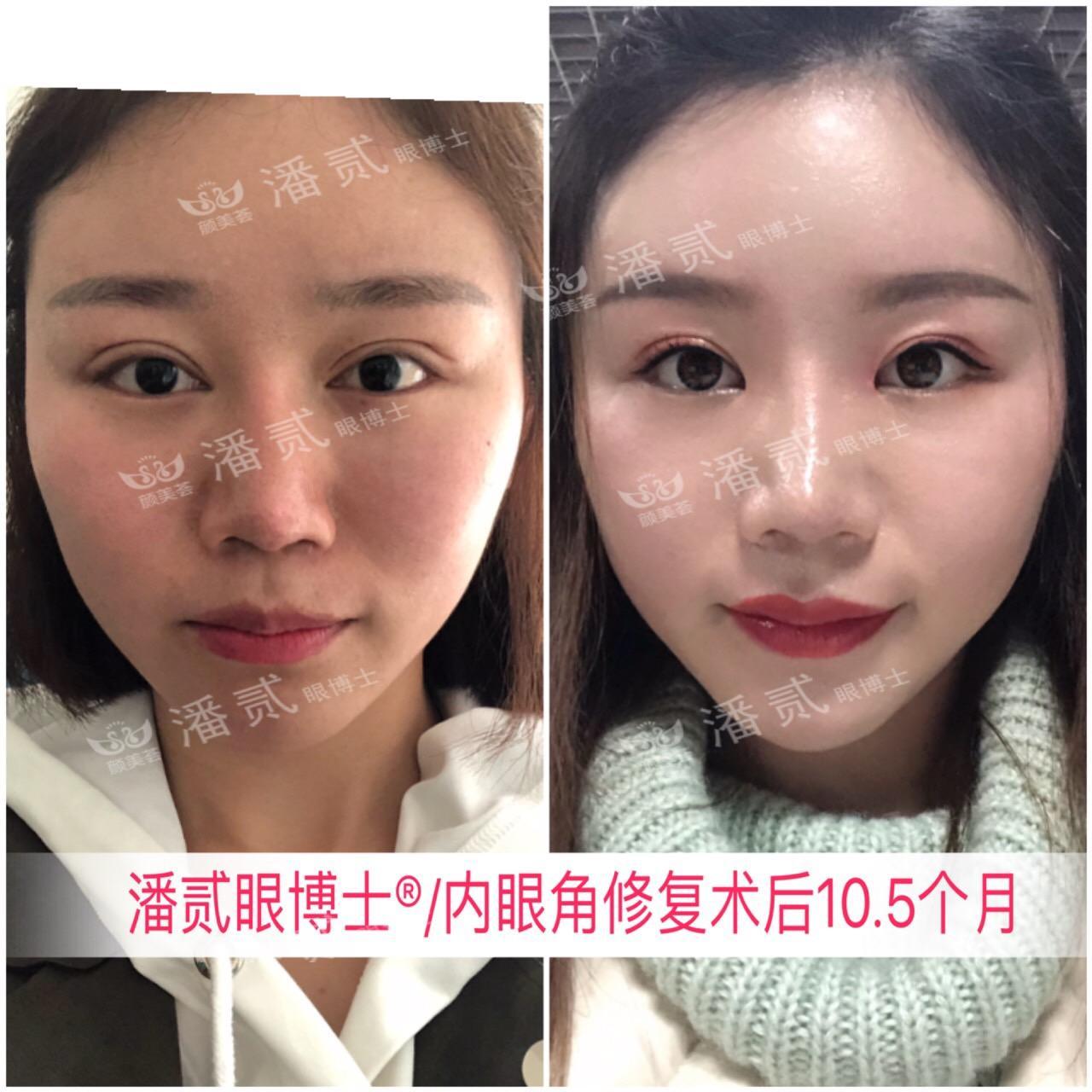 開眼角前后對比照片 開眼角失敗的八種圖片