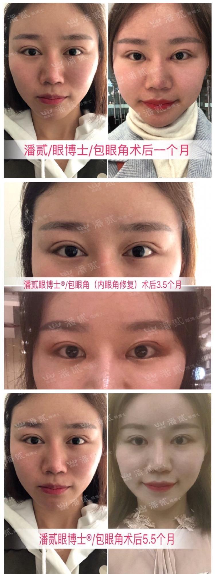 開眼角前后對比照片 開眼角失敗的八種圖片