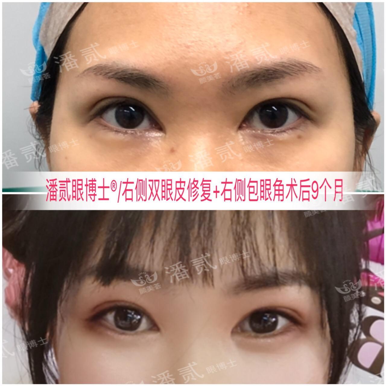 開眼角前后對比照片 開眼角失敗的八種圖片